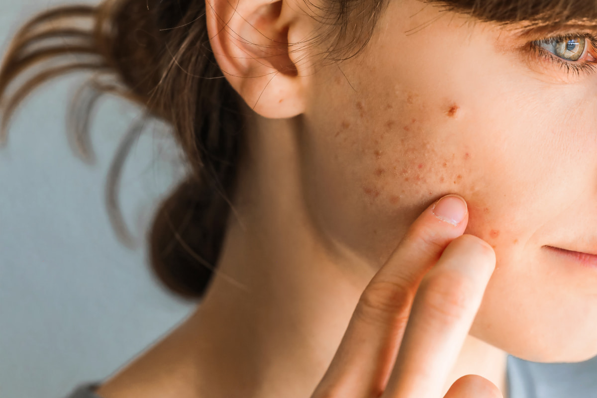 What are the remedies for facial acne?